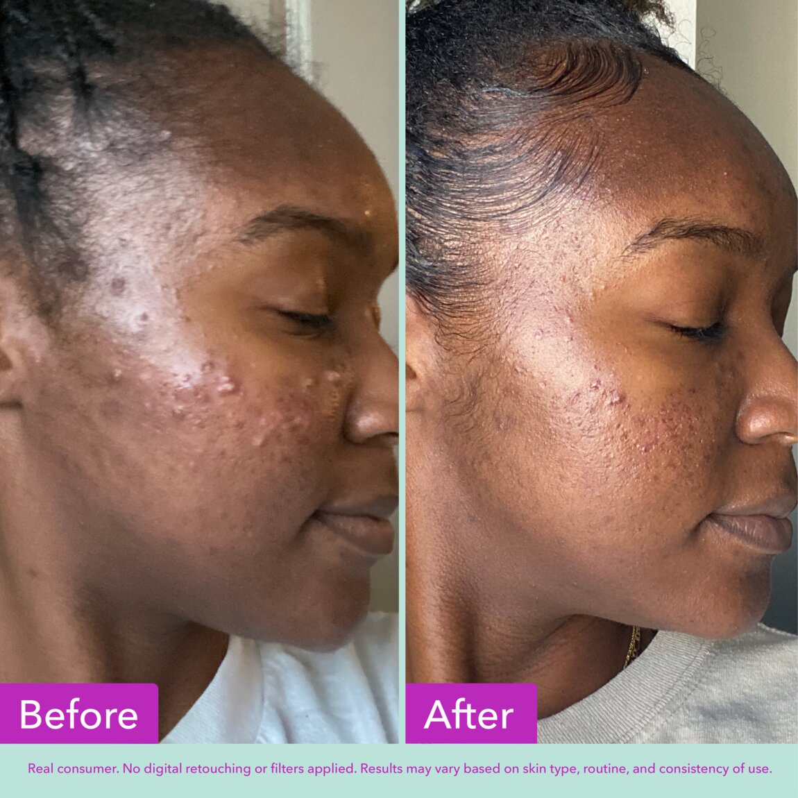 acne-foaming-cleanser-y2 zb_p.jpg